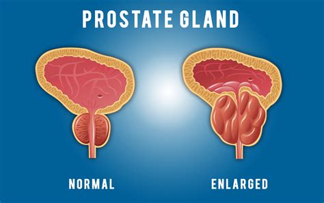 prostate 뜻